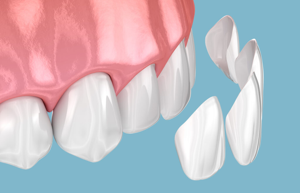 An illustration of tooth veneers