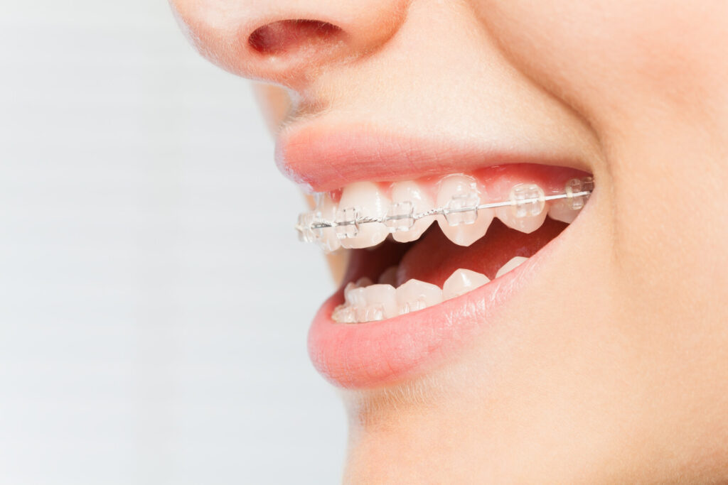 Woman wearing dental braces 
