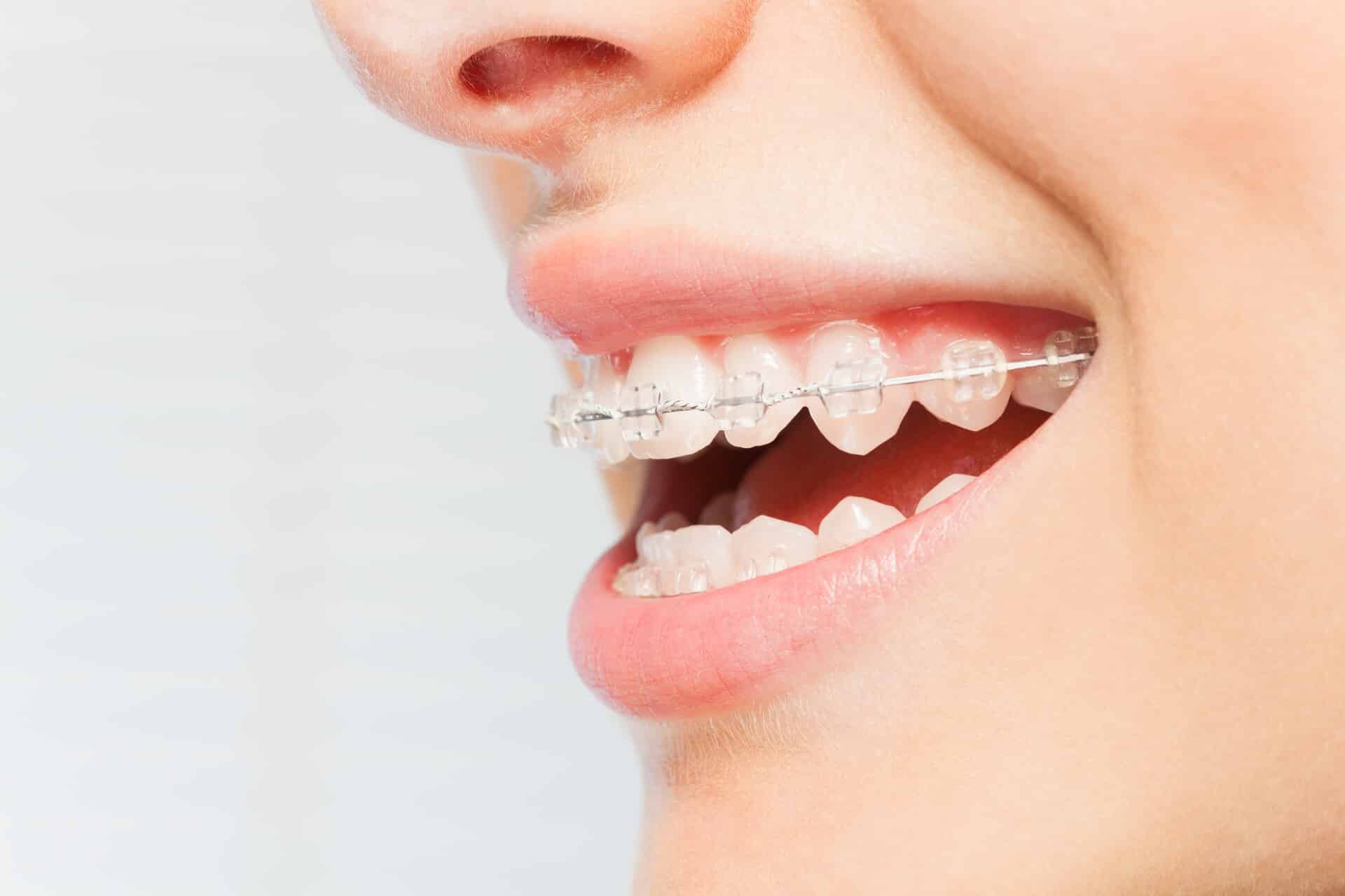 Woman wearing dental braces