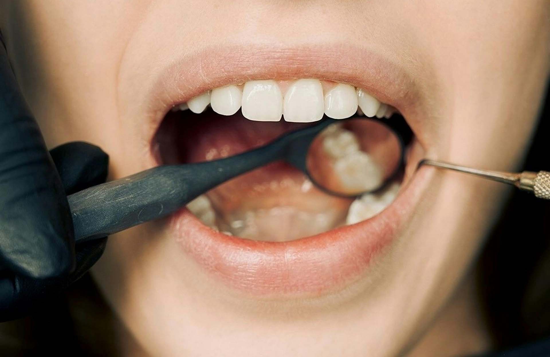 A dentist checking the teeth of a person