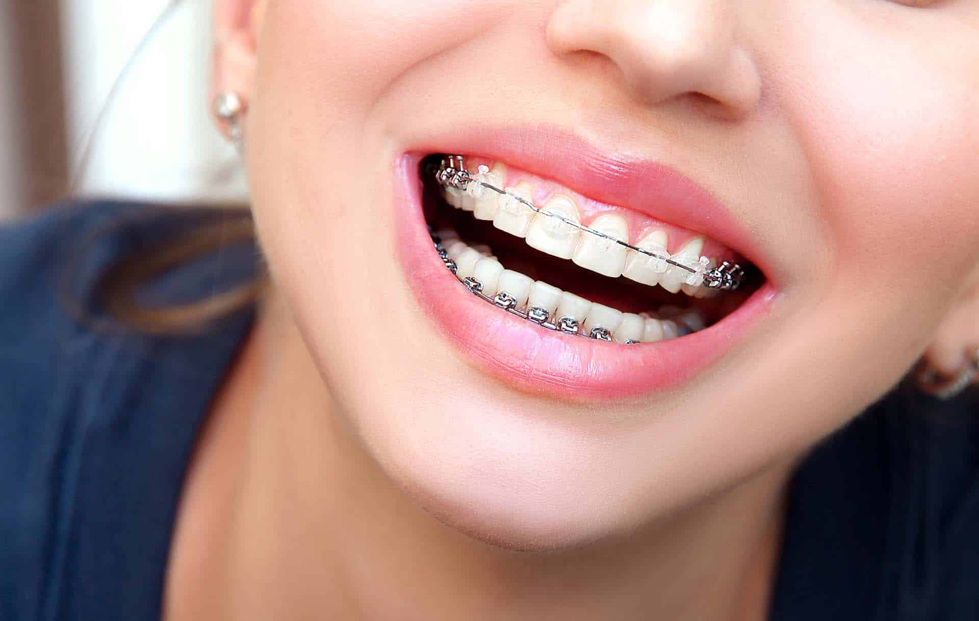 A girl wearing braces