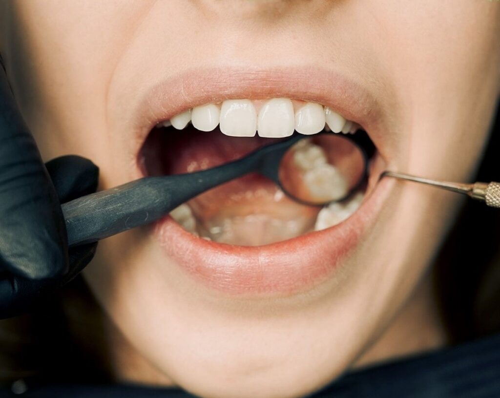 Charlotte dentist using a mouth mirror to check the gums around a patient's back teeth